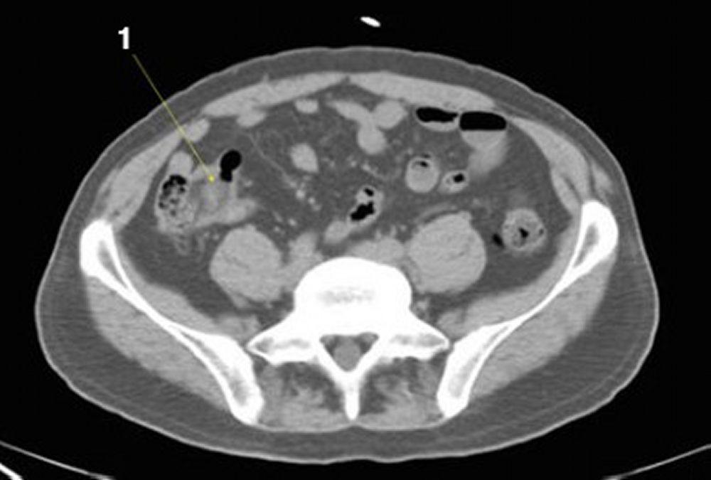 CT-Scan von Abdomen und Becken mit normaler Anatomie ohne Kontrastmittel (Folie 21)