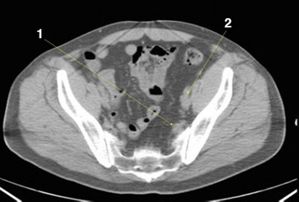 Noncontrast CT Scan of the Abdomen and Pelvis Showing Normal Anatomy (Slide 24)