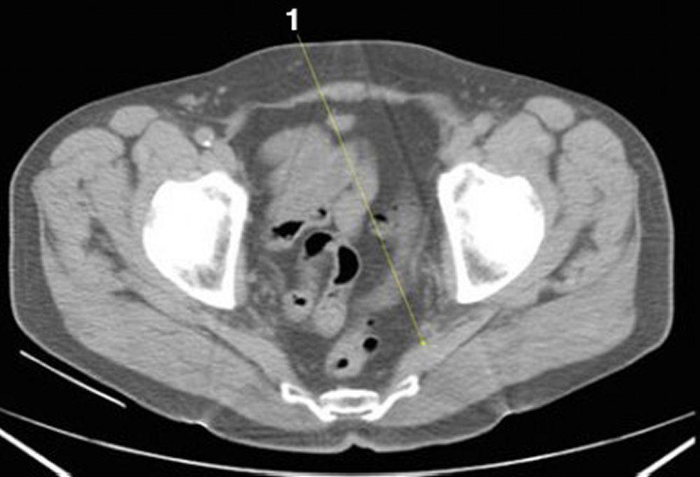 CT-Scan von Abdomen und Becken mit normaler Anatomie ohne Kontrastmittel (Folie 26)