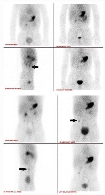 Меккелево сканирование, показывающее дивертикул Меккеля