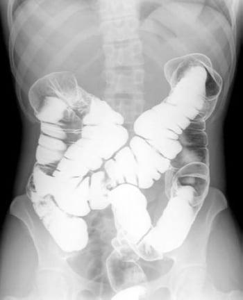 Doppelkontrast-Bariumeinlauf mit Darstellung der normalen Anatomie