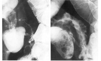 Exame contrastado do trânsito no intestino delgado na doença de Crohn mostrando sinal de cordão