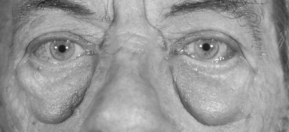 Manifestações oculares da doença de Graves — bolsas infraorbitais