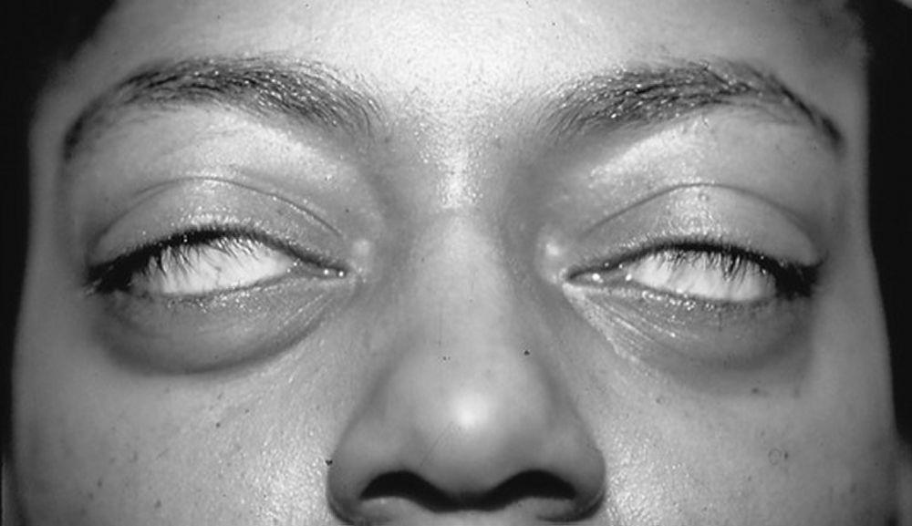 Manifestations oculaires de la maladie de Basedow, incapacité à fermer les yeux