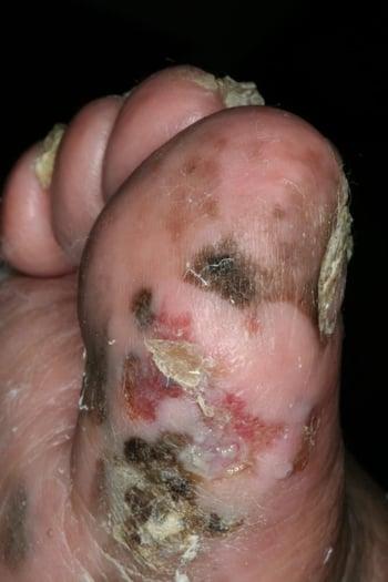 Melanoma lentiginoso acral (dedo del pie)
