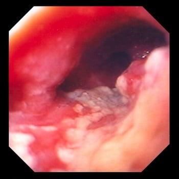 Adenocarcinoma dell'esofago