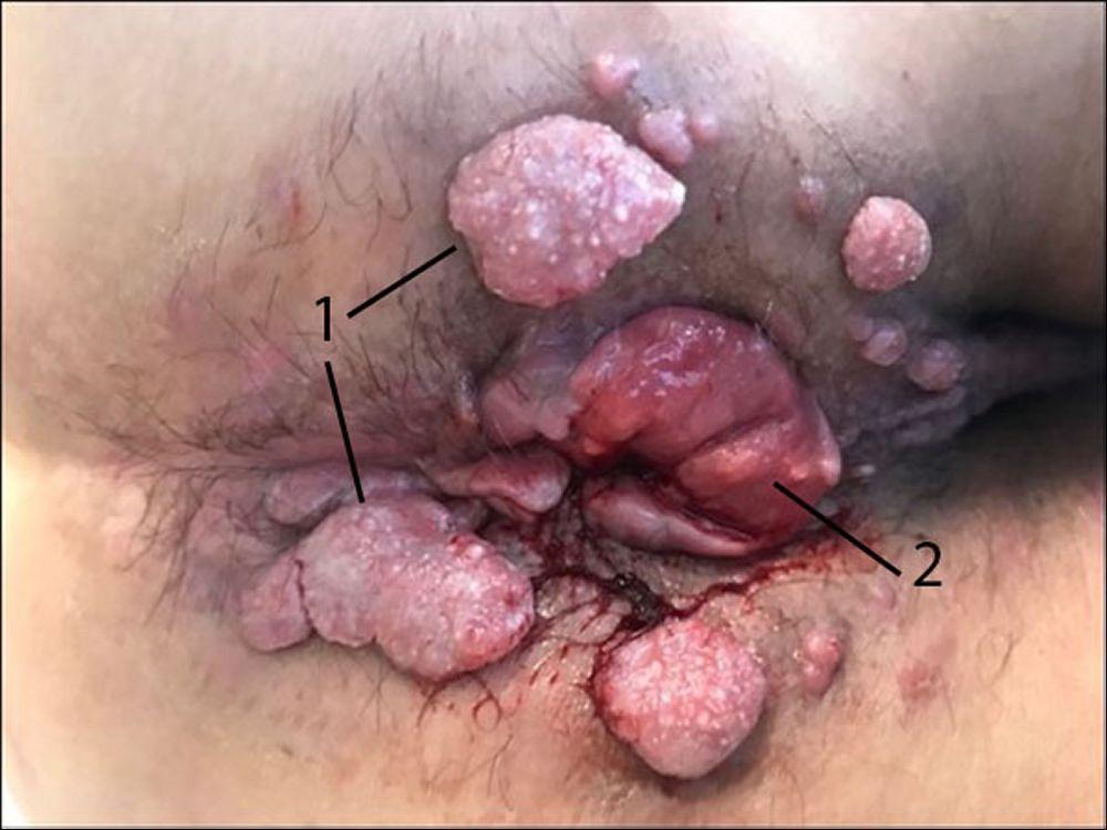 Carcinoma anal