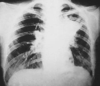 Blastomicose pulmonar