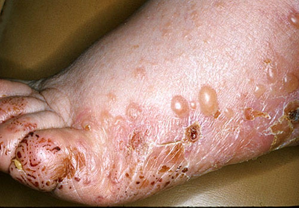 Pemphigoid bọng nước trên bàn chân