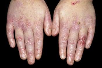 Epidermolysis bullosa (Hände)