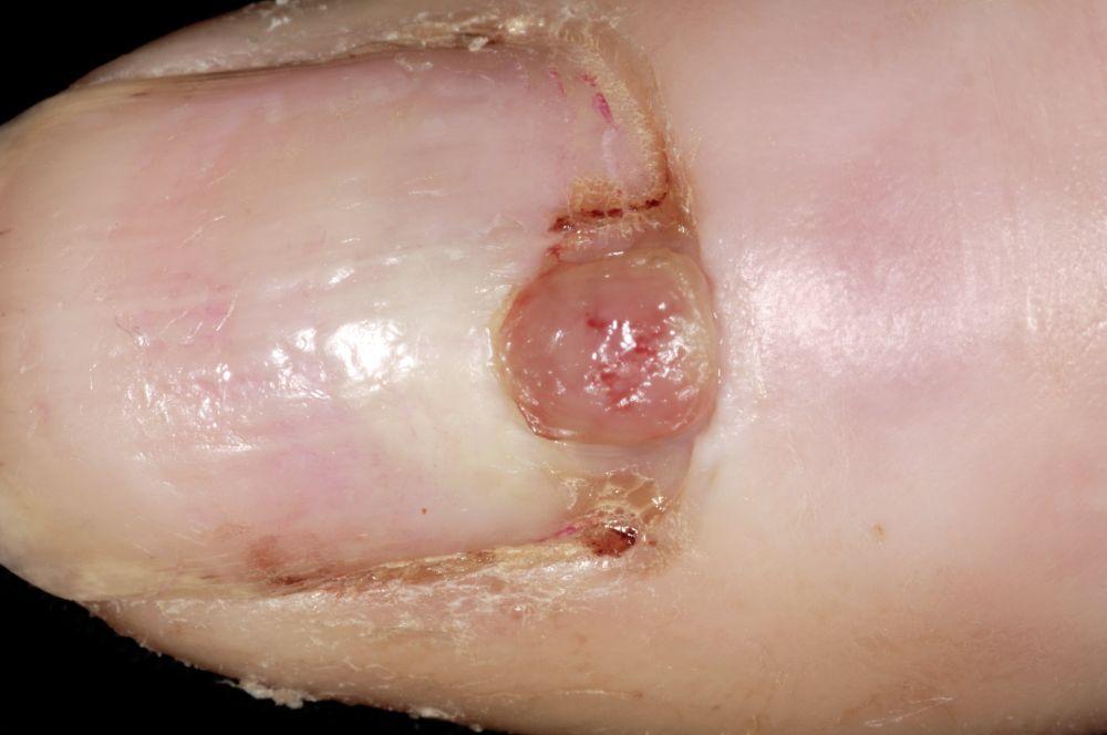 Granuloma piógeno (uña)