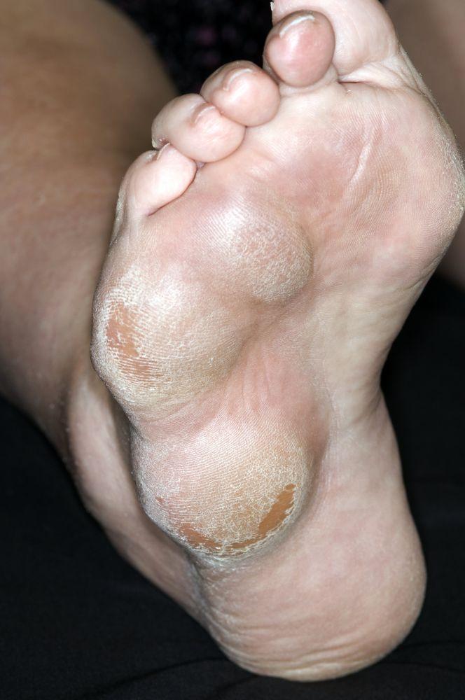 Nódulos reumatoides (pés)