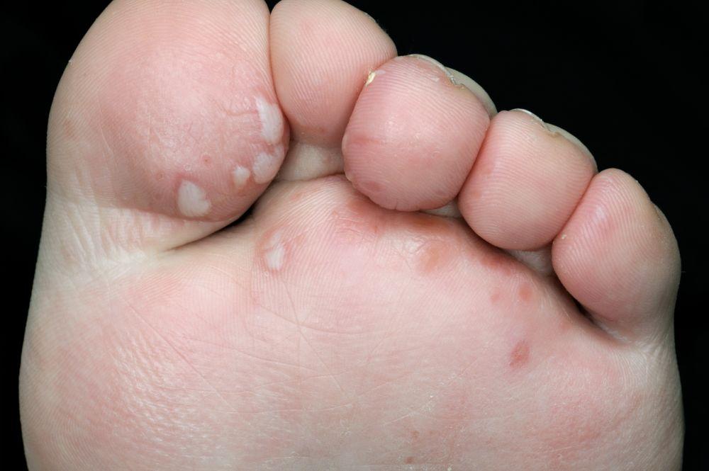 Hand-Fuß-Mund-Krankheit (Fußläsionen)