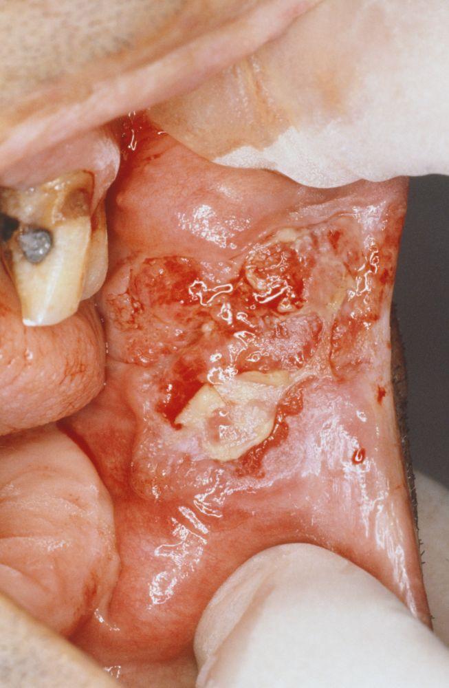 Carcinoma oral de células escamosas