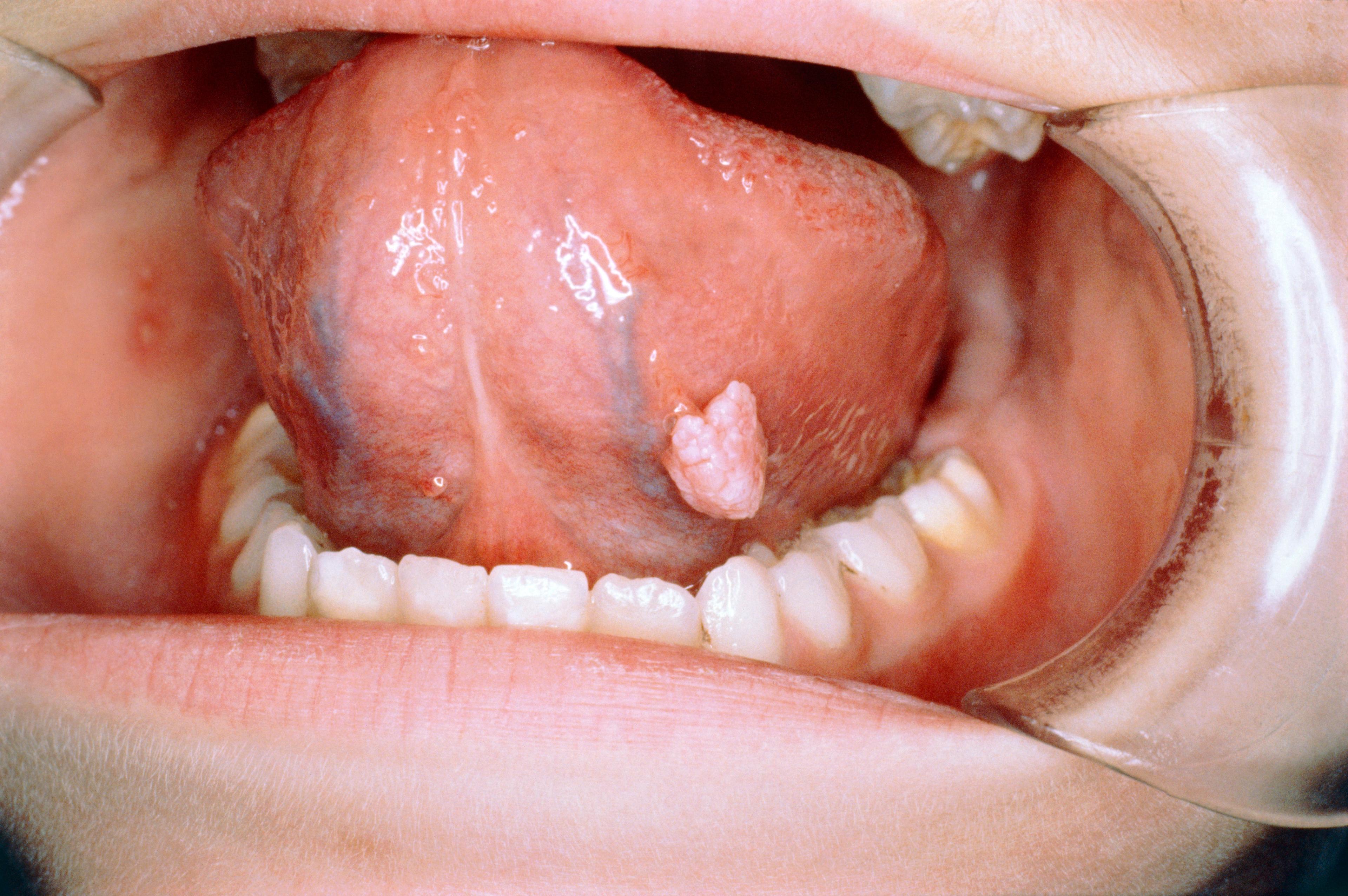 舌の乳頭腫