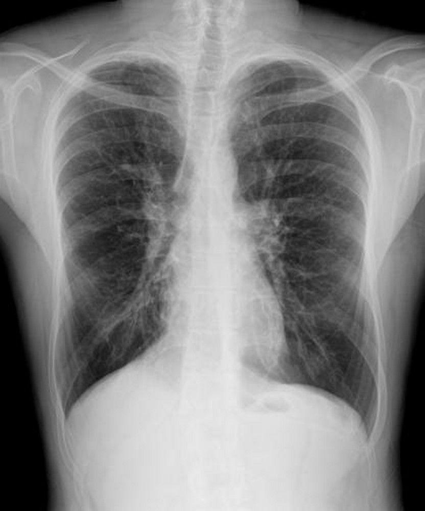 Cystic Fibrosis (X-Ray)