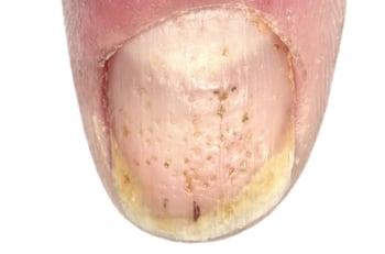 Solchi nelle unghie causati dall'artrite psoriasica idiopatica giovanile
