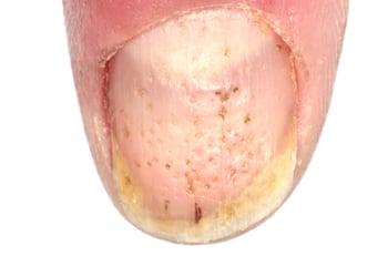 乾癬性JIAによる爪の点状陥凹