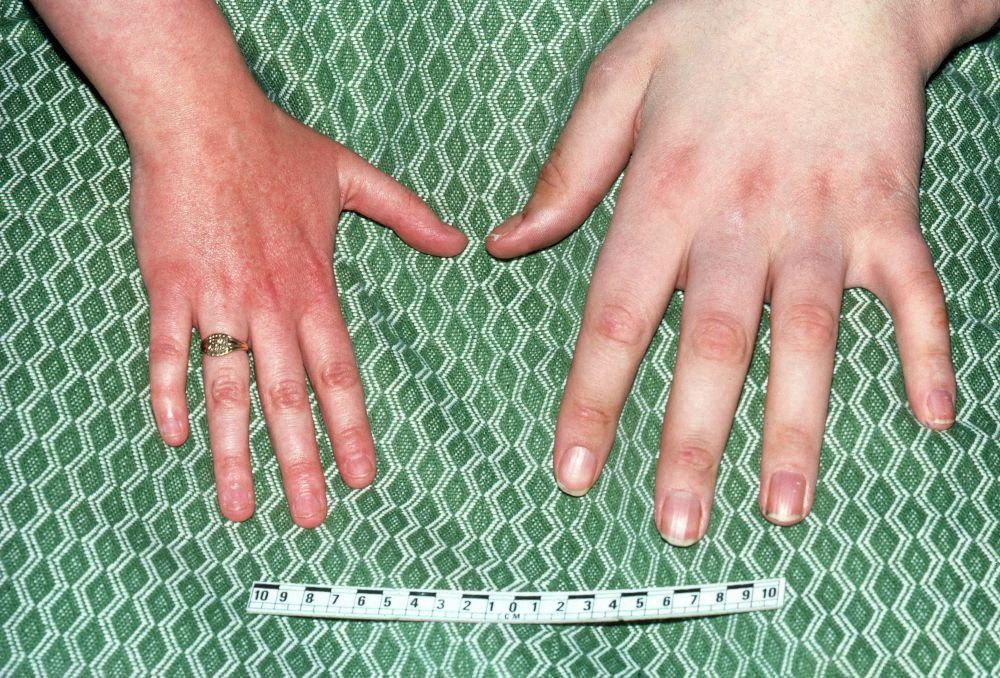 Acromegalia (reperti della mano)