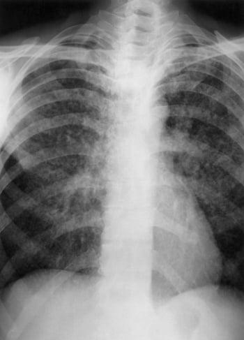 Tuberculosis miliar