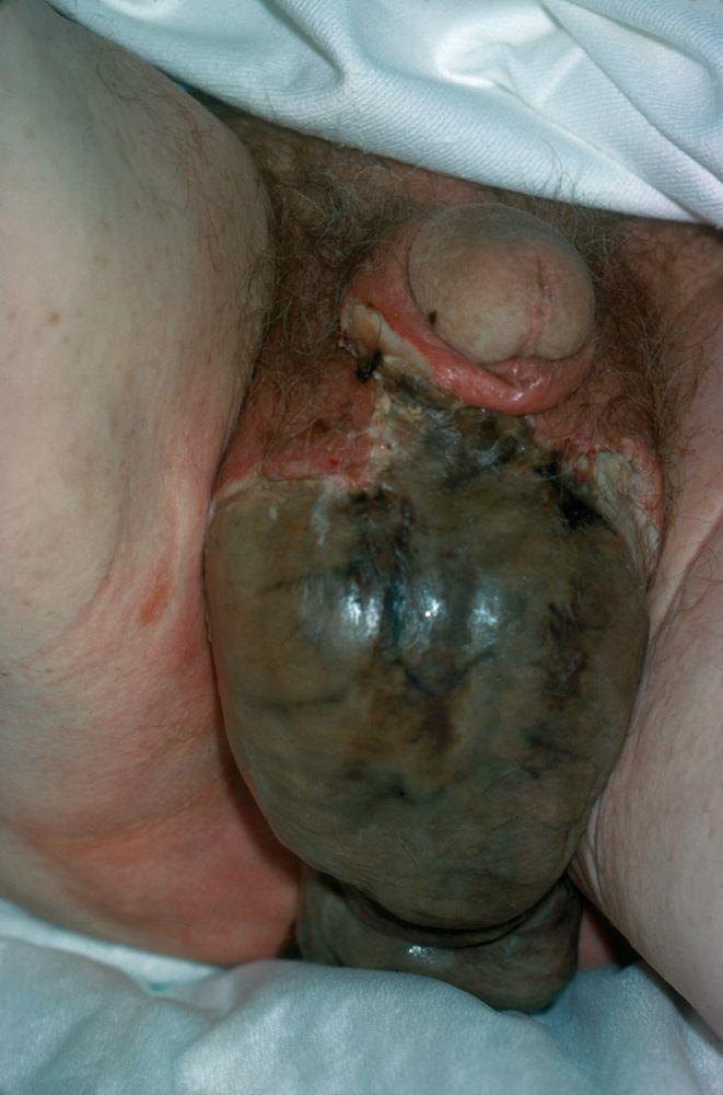 Gangrena de Fournier (infección subcutánea necrosante del periné)