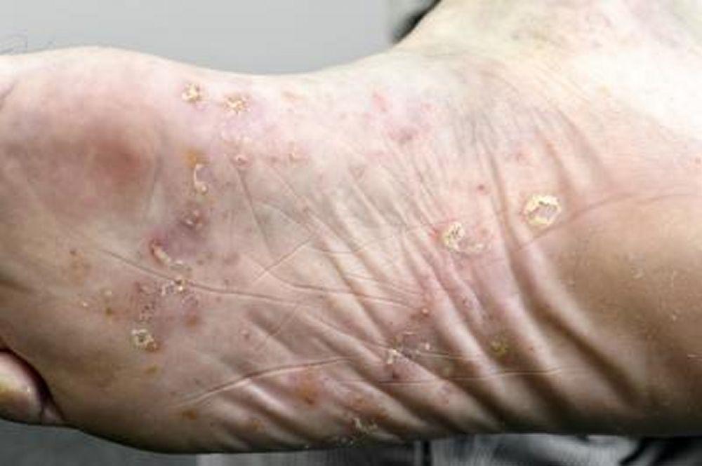 Psoriasis palmoplantaris (Fußsohlen)