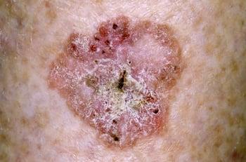 Carcinoma a cellule squamose in situ (tibia)