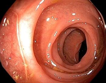 Endoscopie (gros intestin)