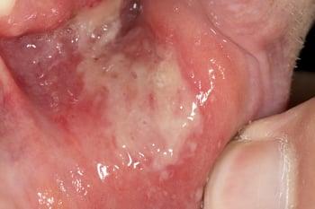 Major Aphthous Ulcer