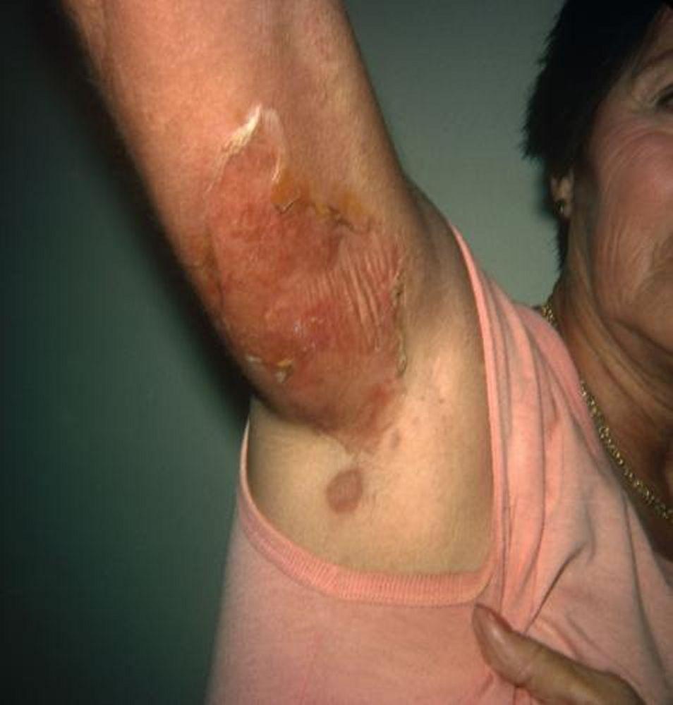 Síndrome estafilocócico de la piel escalcada (adulto)