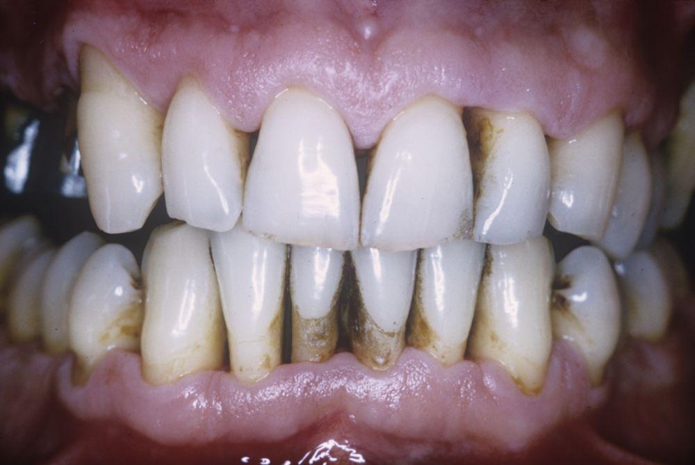 Parodontite (perte des tissus de soutien de la dent)