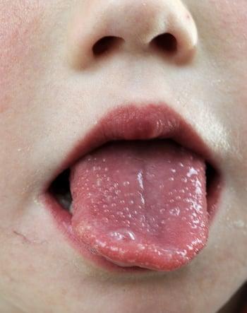 Strawberry Tongue (Child)
