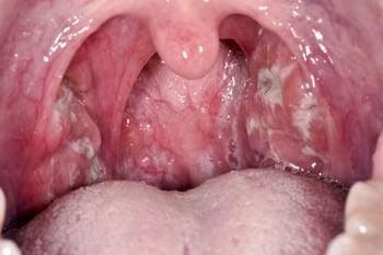 レンサ球菌咽頭炎