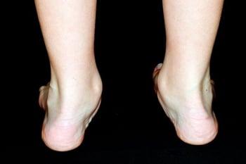 Pes Planus (Flat Feet)