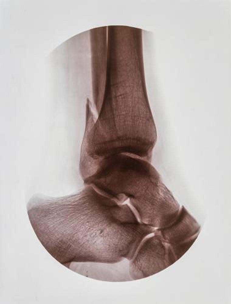 Fratura do tornozelo posterior (fibular)