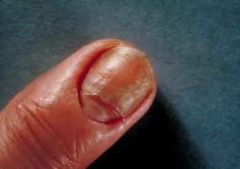 Candidiasis (infección de las uñas)