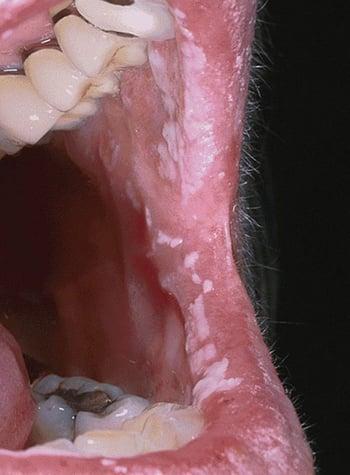 Candidiasis bucal (muguet)