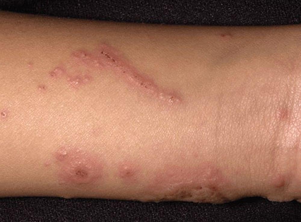 Dermatite da contatto (allergica)