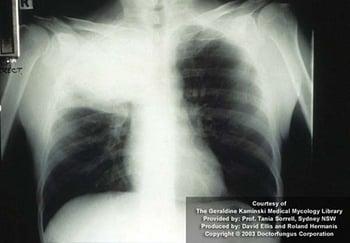 Criptococose (pulmonar)