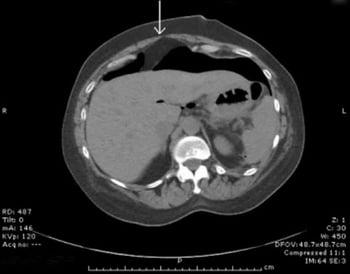 CT With Free Peritoneal Air