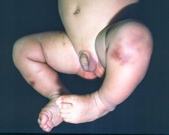 Mastocitosi cutanea (gambe)