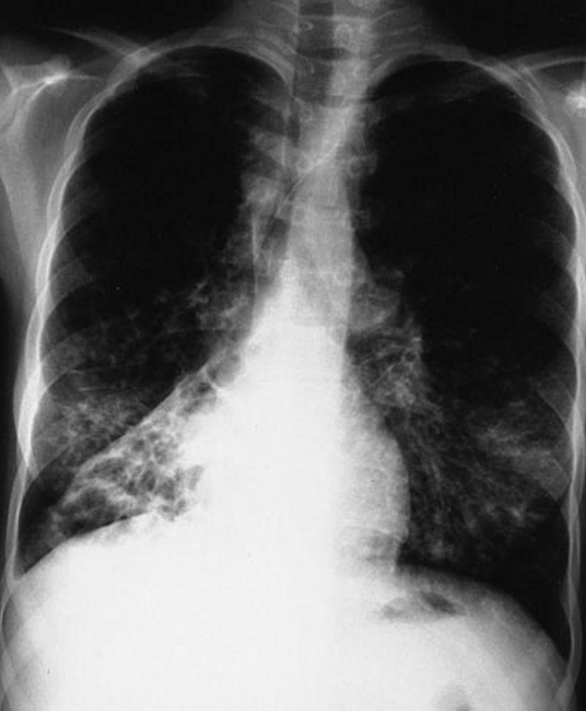Fibrosis quística (radiografía de tórax)