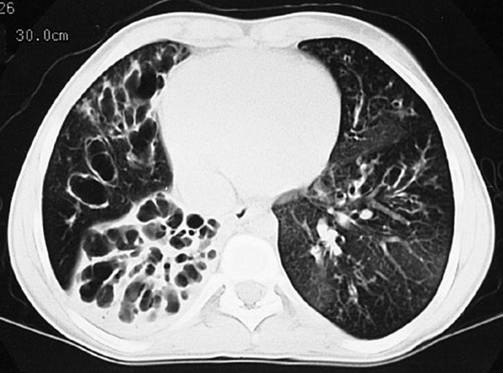 Cystic Fibrosis (CT Scan)