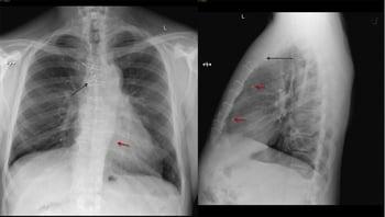 Radiografia del torace di un paziente dopo un intervento di bypass coronarico