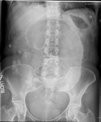 Zäkumvolvulus (Röntgenaufnahme des Abdomens)