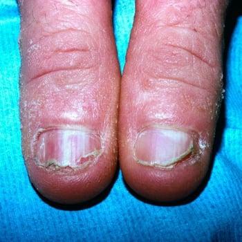Болезнь Дарье (ногти)