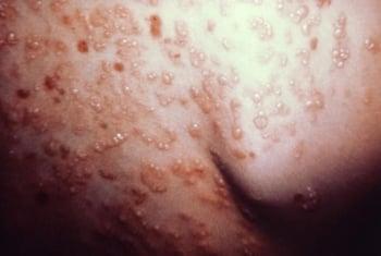 Dermatitis herpetiformis verursacht durch Zöliakie