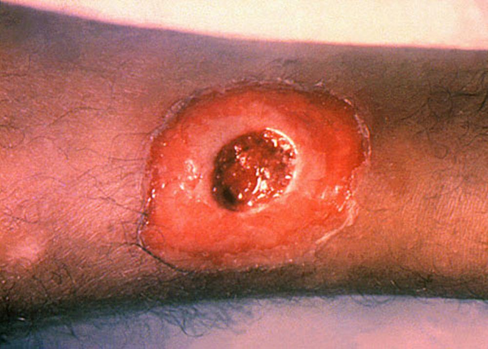 Difteria cutânea (ulceração central)