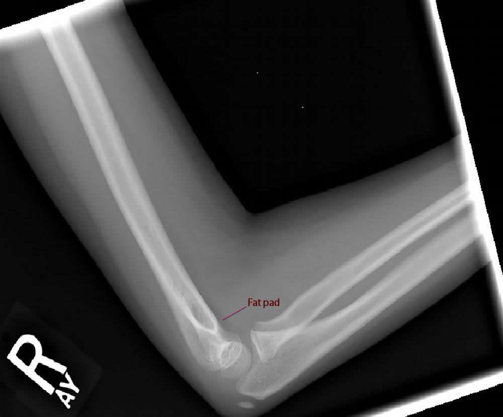 Phim chụp X-quang nghiêng của khuỷu tay