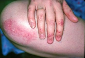 Epidermolysis bullosa (Hand und Knie)